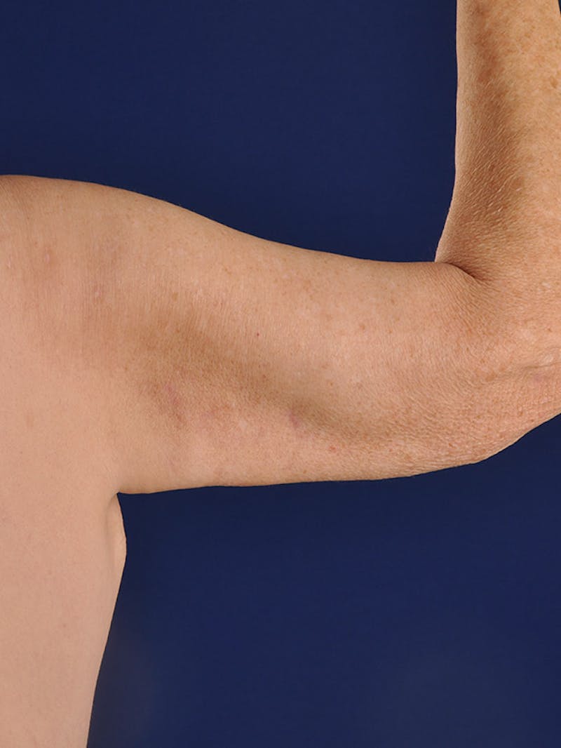 Arms Before & After Gallery - Patient 18264583 - Image 6