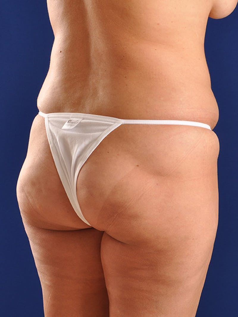 Fat Transfer Buttocks (Brazilian Butt Lift) Before & After Gallery - Patient 18264587 - Image 1