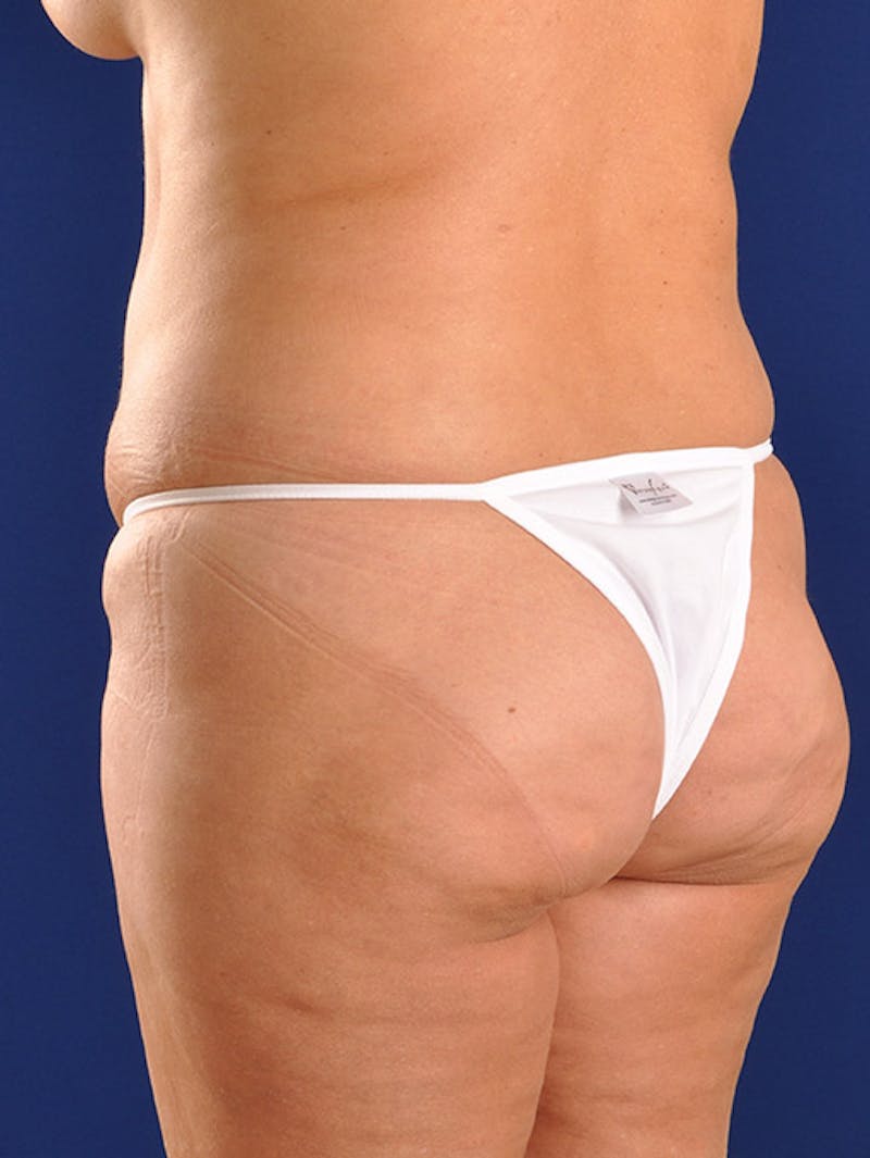Fat Transfer Buttocks (Brazilian Butt Lift) Before & After Gallery - Patient 18264587 - Image 3