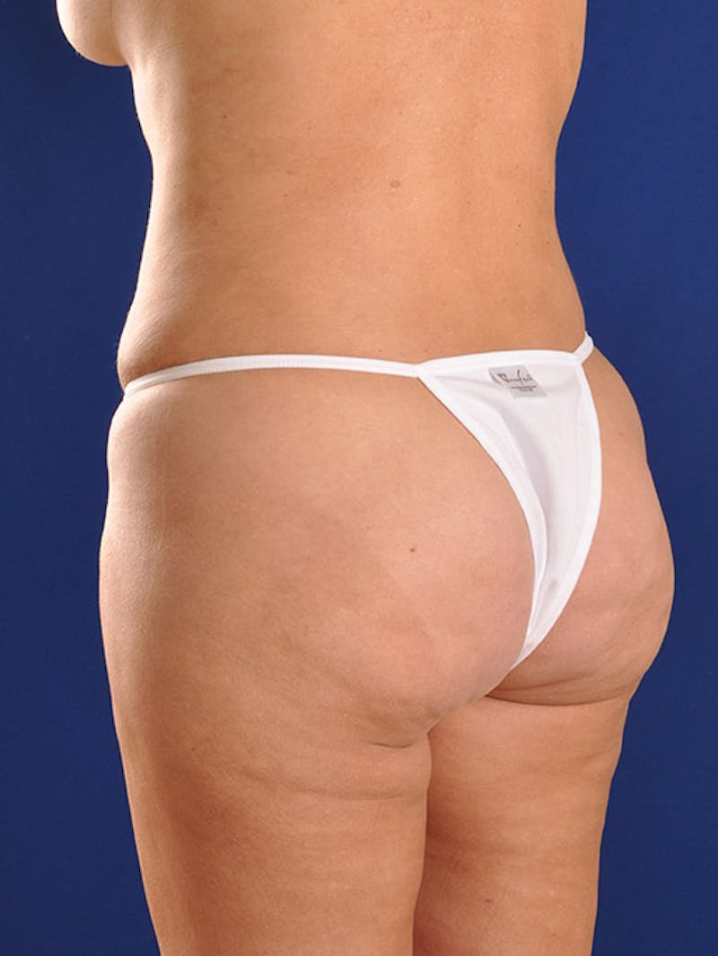 Fat Transfer Buttocks (Brazilian Butt Lift) Before & After Gallery - Patient 18264587 - Image 4