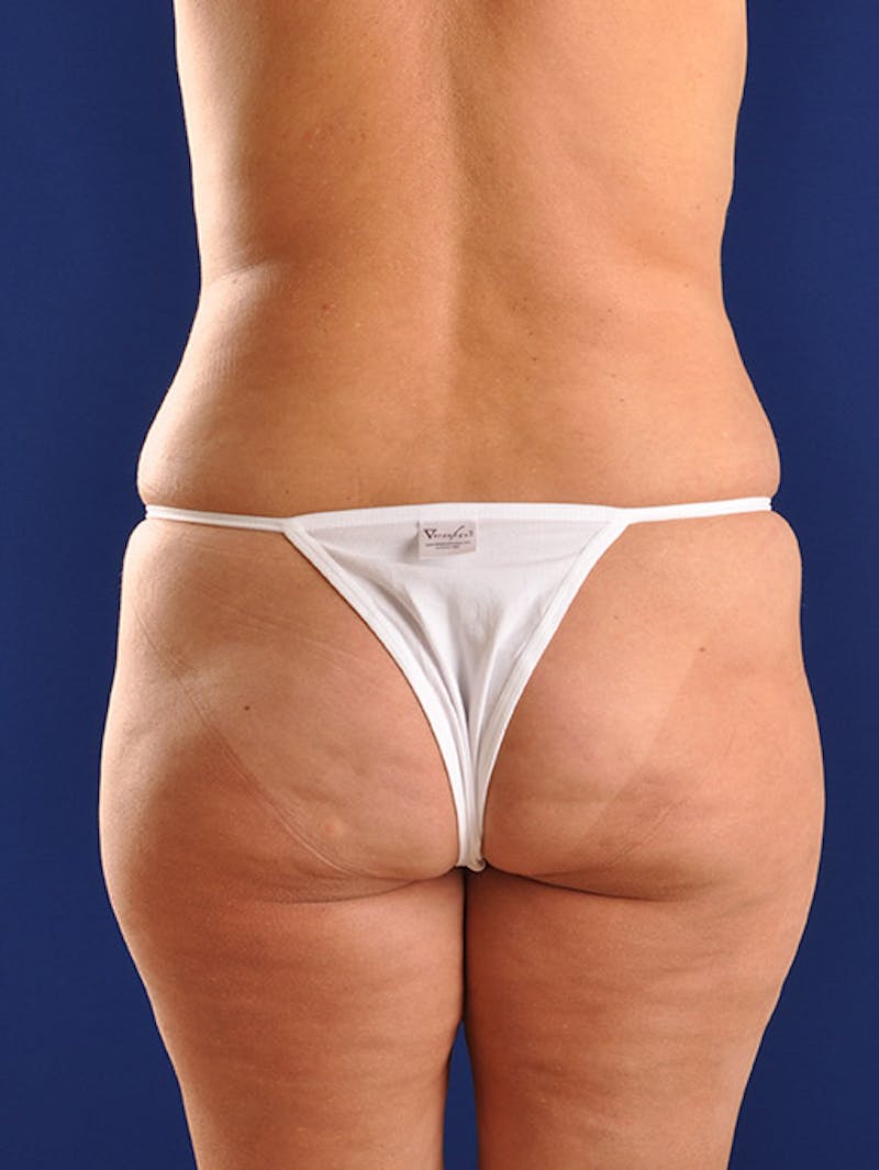 Fat Transfer Buttocks (Brazilian Butt Lift) Before & After Gallery - Patient 18264587 - Image 5