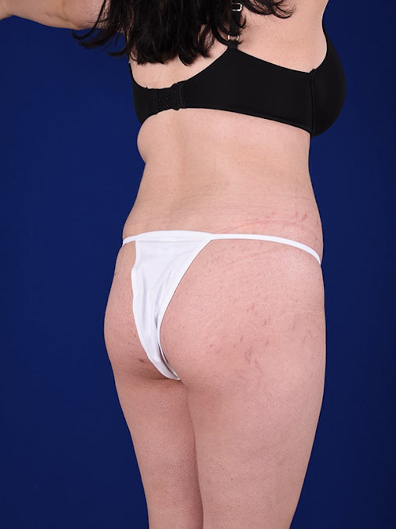 Fat Transfer Buttocks (Brazilian Butt Lift) Before & After Gallery - Patient 18264902 - Image 1