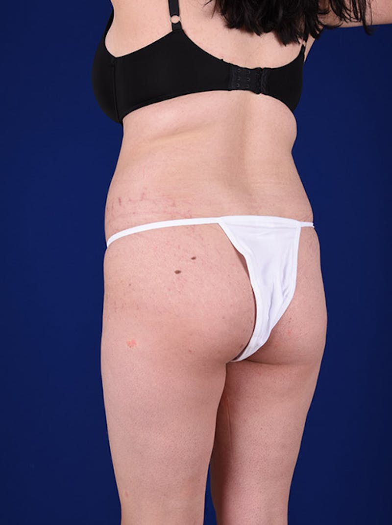 Fat Transfer Buttocks (Brazilian Butt Lift) Before & After Gallery - Patient 18264902 - Image 3