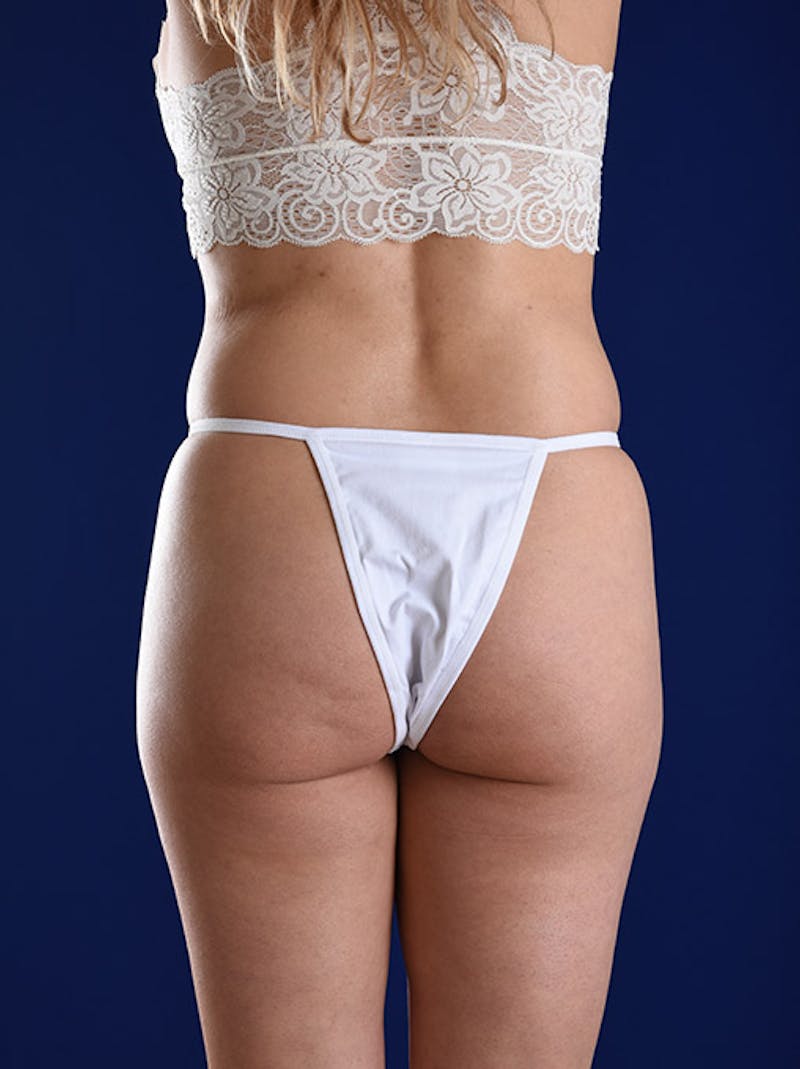 Fat Transfer Buttocks (Brazilian Butt Lift) Before & After Gallery - Patient 18264944 - Image 5