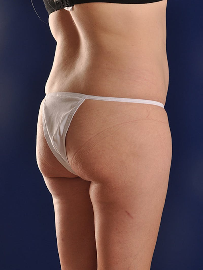 Fat Transfer Buttocks (Brazilian Butt Lift) Before & After Gallery - Patient 18264960 - Image 1