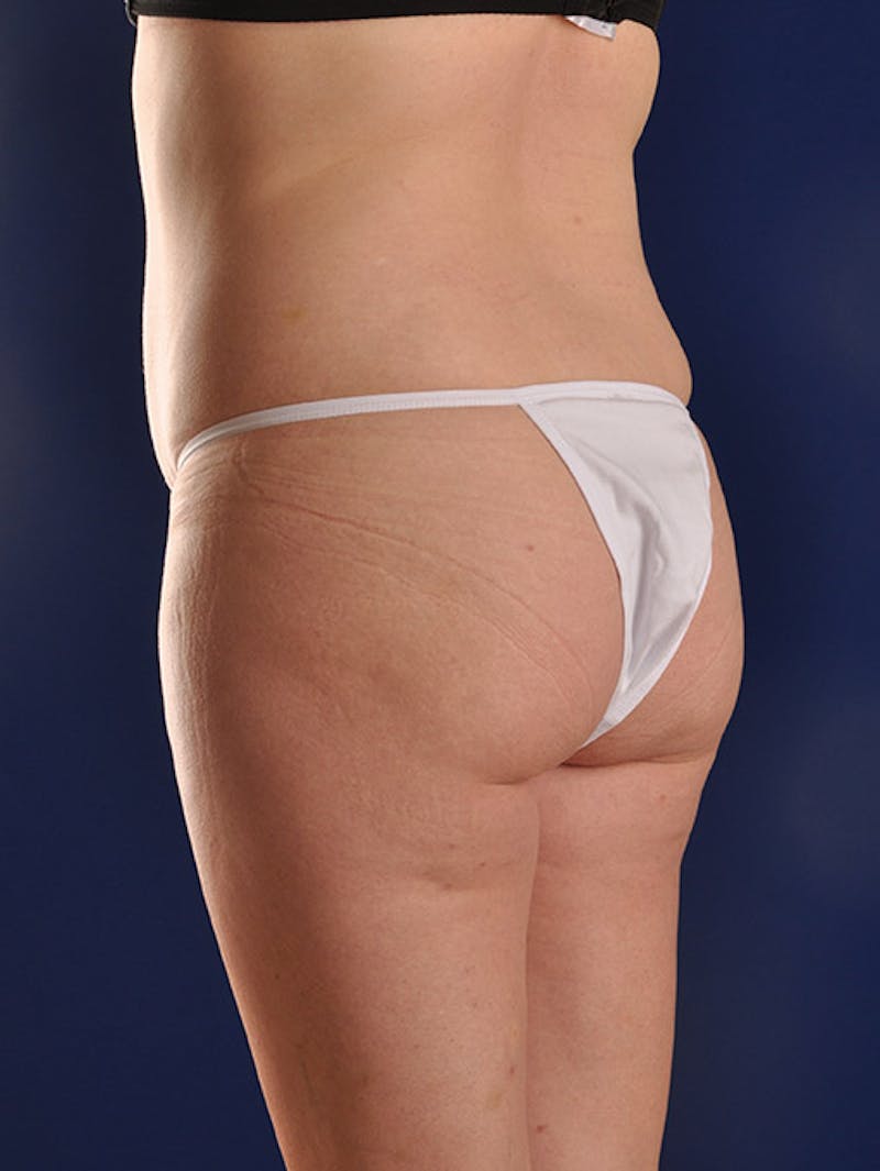 Fat Transfer Buttocks (Brazilian Butt Lift) Before & After Gallery - Patient 18264960 - Image 3