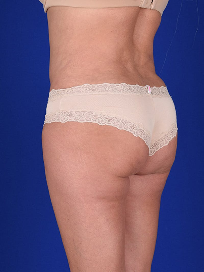 Fat Transfer Buttocks (Brazilian Butt Lift) Before & After Gallery - Patient 18264960 - Image 4