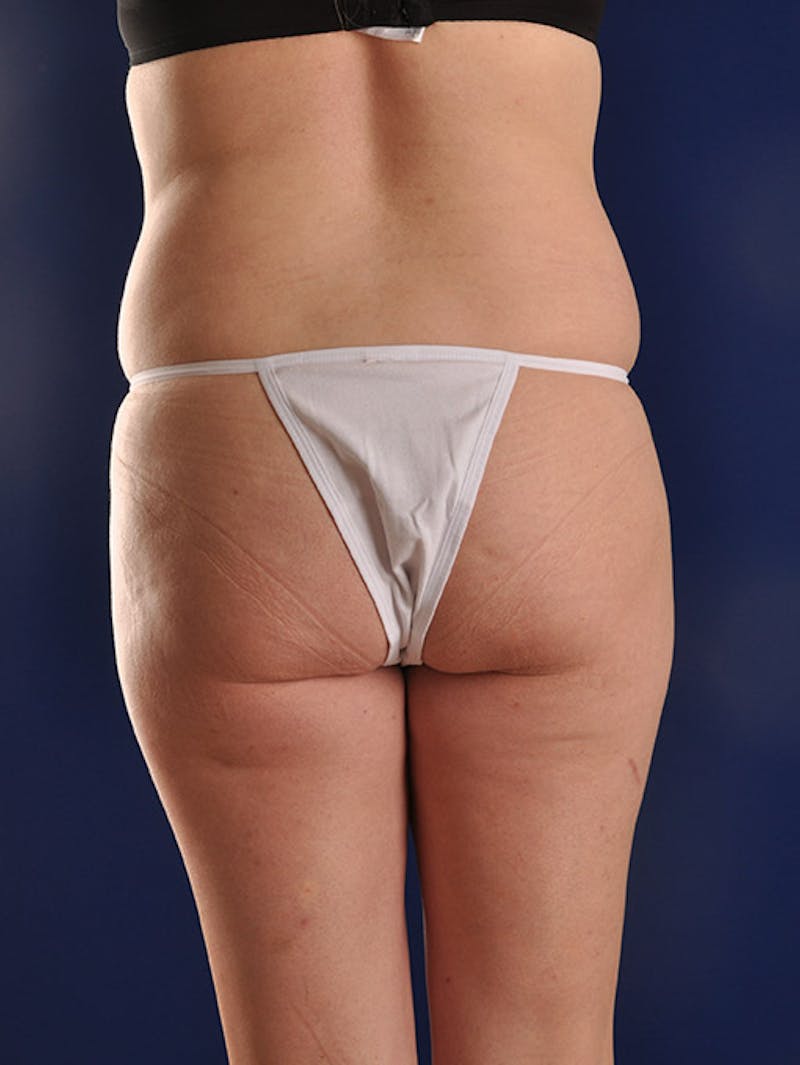 Fat Transfer Buttocks (Brazilian Butt Lift) Before & After Gallery - Patient 18264960 - Image 5