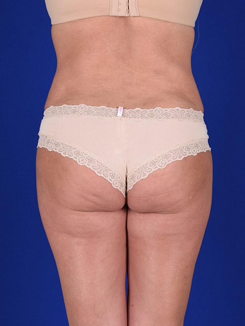 Fat Transfer Buttocks (Brazilian Butt Lift) Before & After Gallery - Patient 18264960 - Image 6