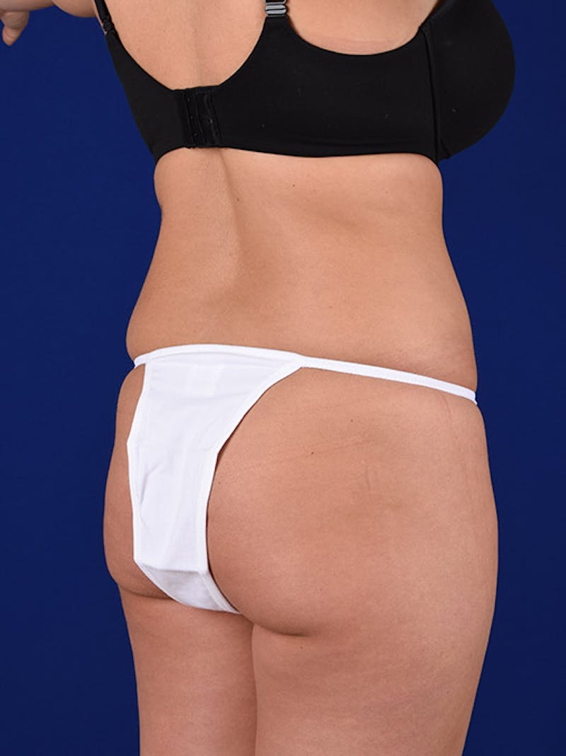 Fat Transfer Buttocks (Brazilian Butt Lift) Before & After Gallery - Patient 18264972 - Image 1