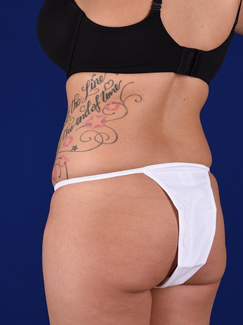 Fat Transfer Buttocks (Brazilian Butt Lift) Before & After Gallery - Patient 18264972 - Image 3