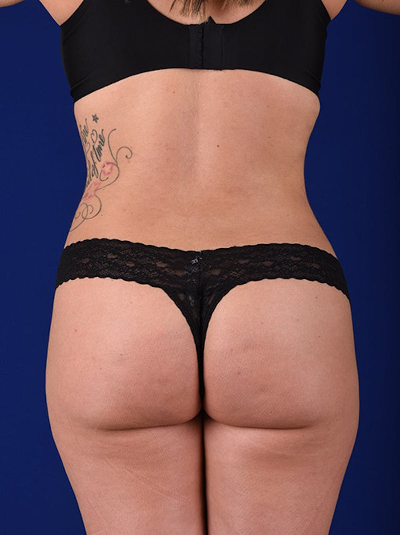 Fat Transfer Buttocks (Brazilian Butt Lift) Before & After Gallery - Patient 18264972 - Image 6
