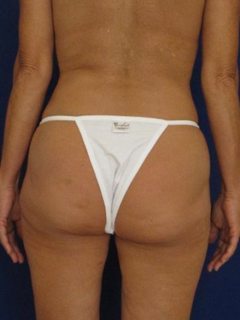 Fat Transfer Buttocks (Brazilian Butt Lift) Before & After Gallery - Patient 18264977 - Image 3