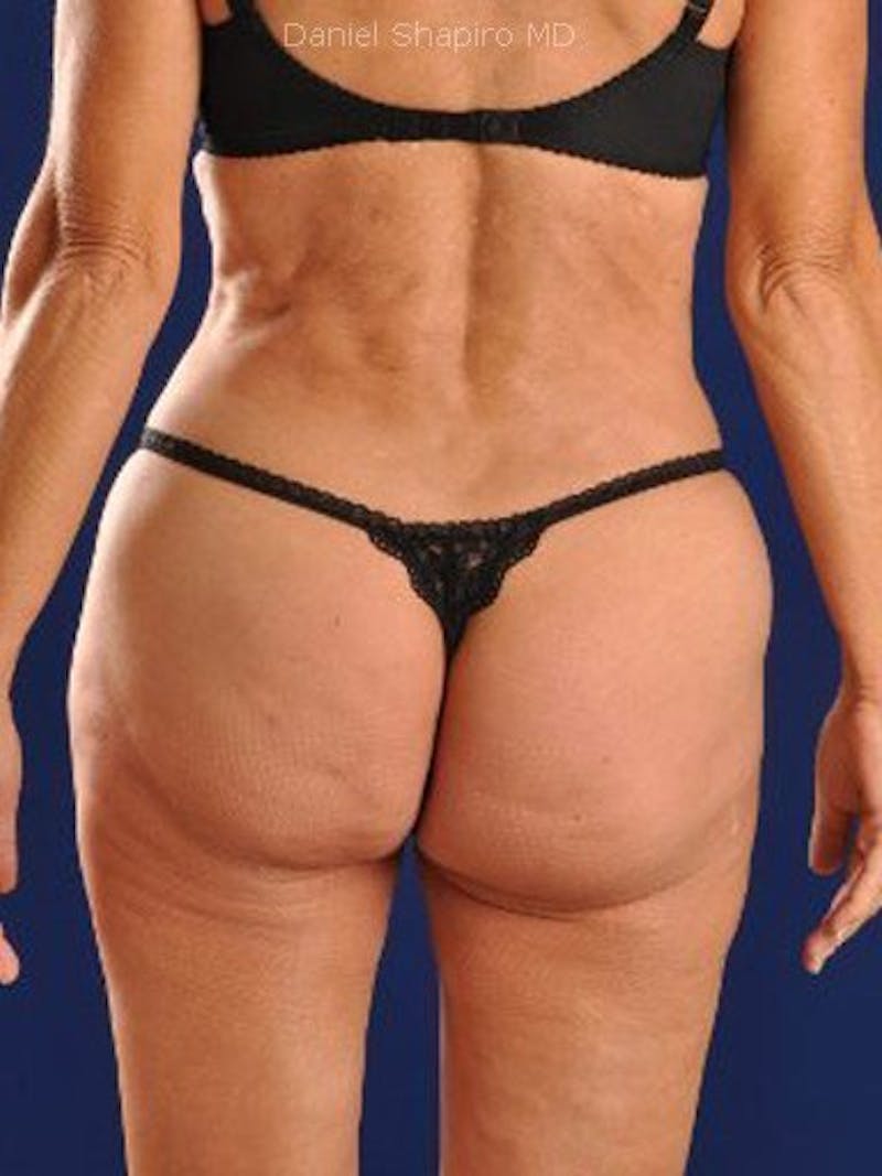 Fat Transfer Buttocks (Brazilian Butt Lift) Before & After Gallery - Patient 18264977 - Image 4