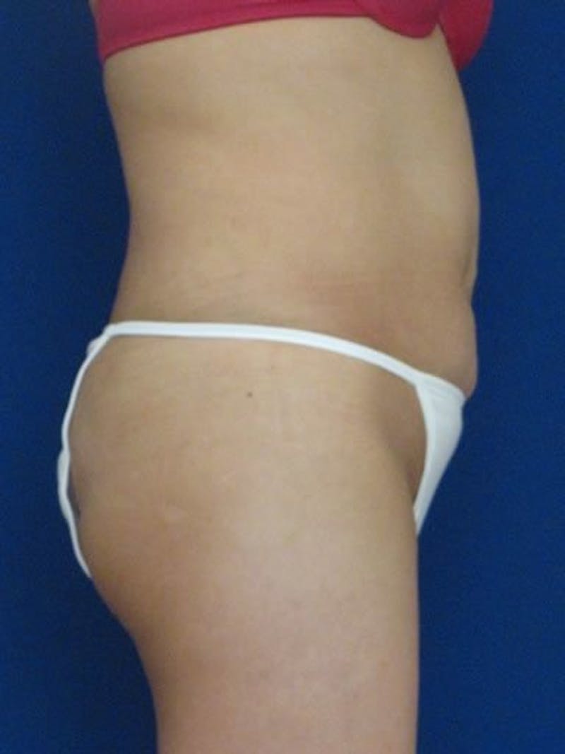 Fat Transfer Buttocks (Brazilian Butt Lift) Before & After Gallery - Patient 18264979 - Image 1