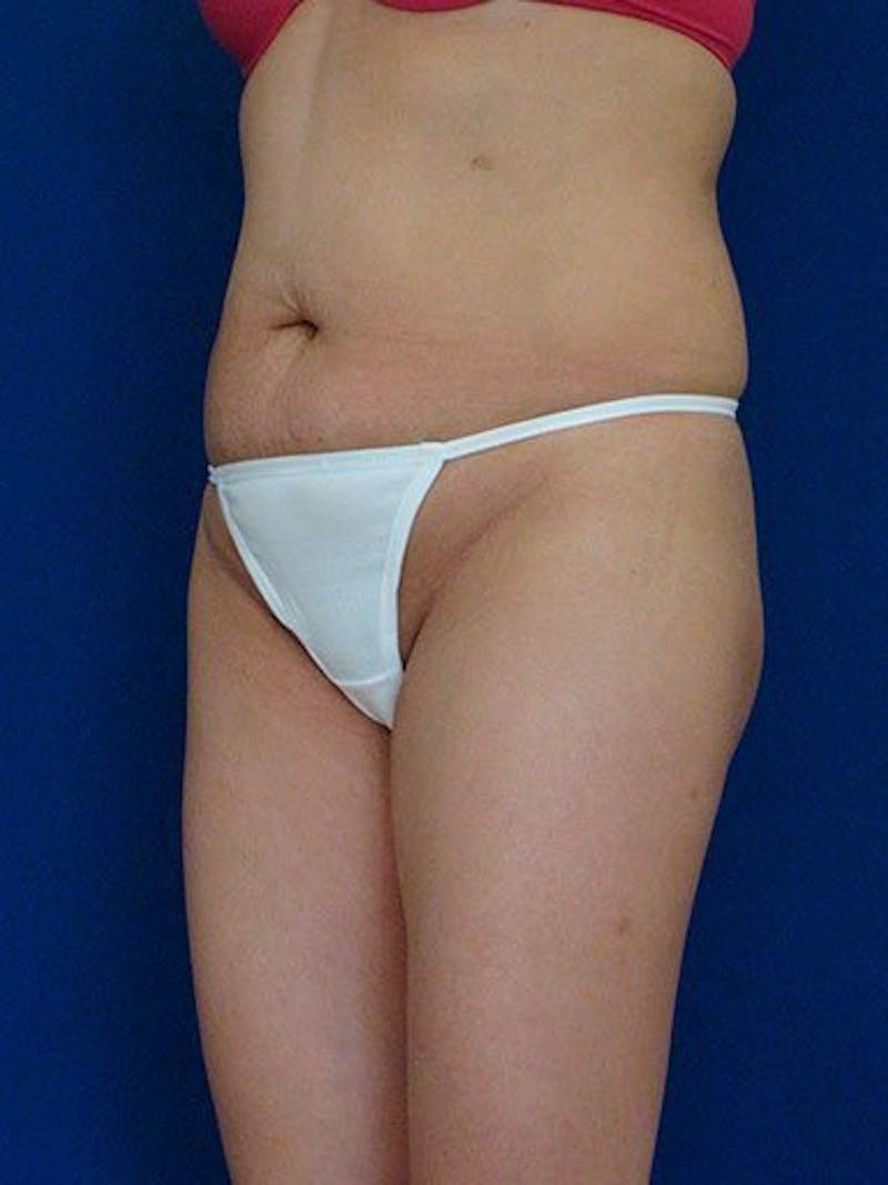 Fat Transfer Buttocks (Brazilian Butt Lift) Before & After Gallery - Patient 18264979 - Image 3