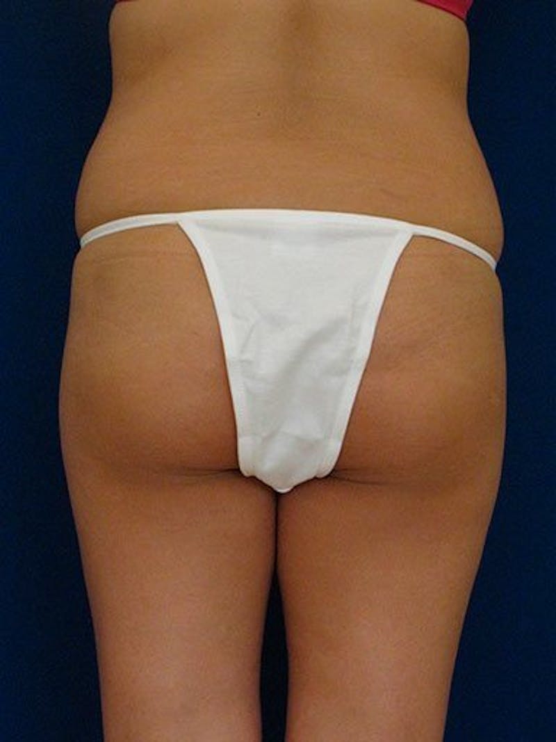 Fat Transfer Buttocks (Brazilian Butt Lift) Before & After Gallery - Patient 18264979 - Image 5