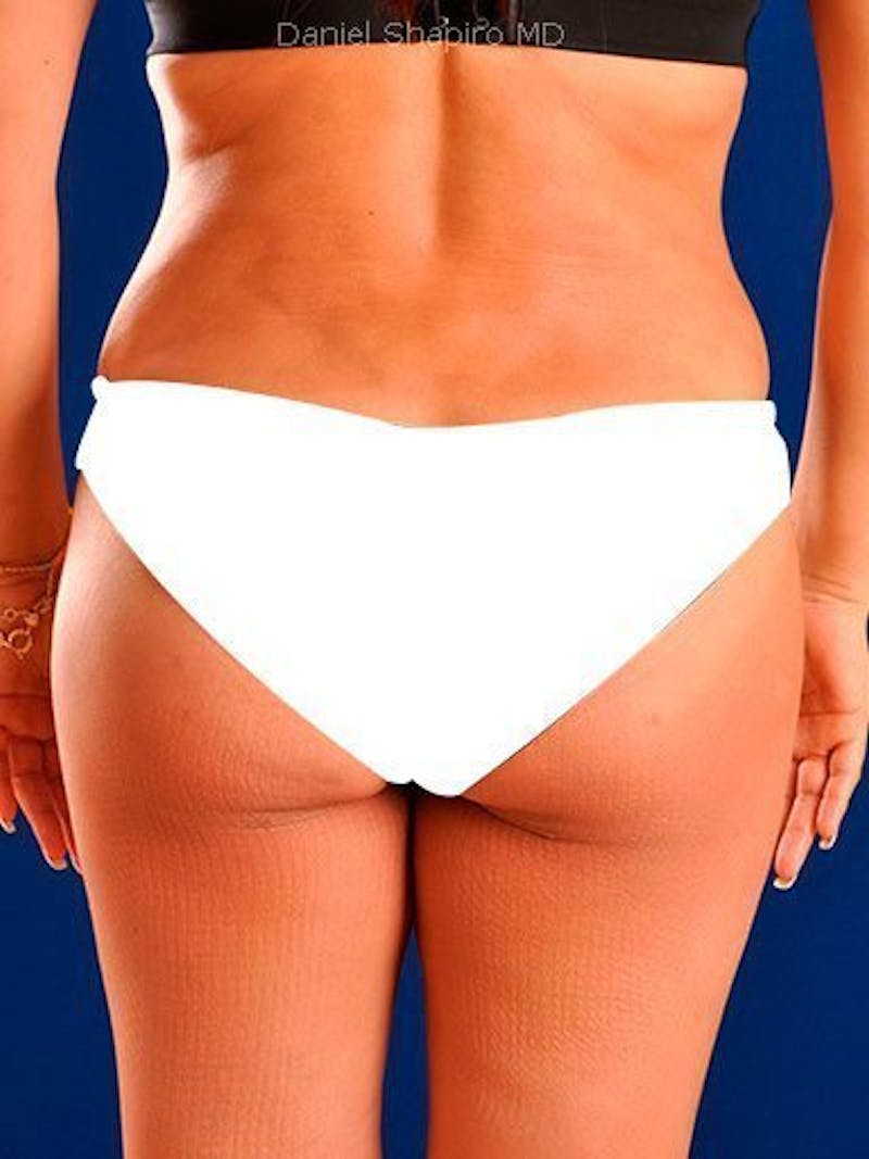 Fat Transfer Buttocks (Brazilian Butt Lift) Before & After Gallery - Patient 18264979 - Image 6