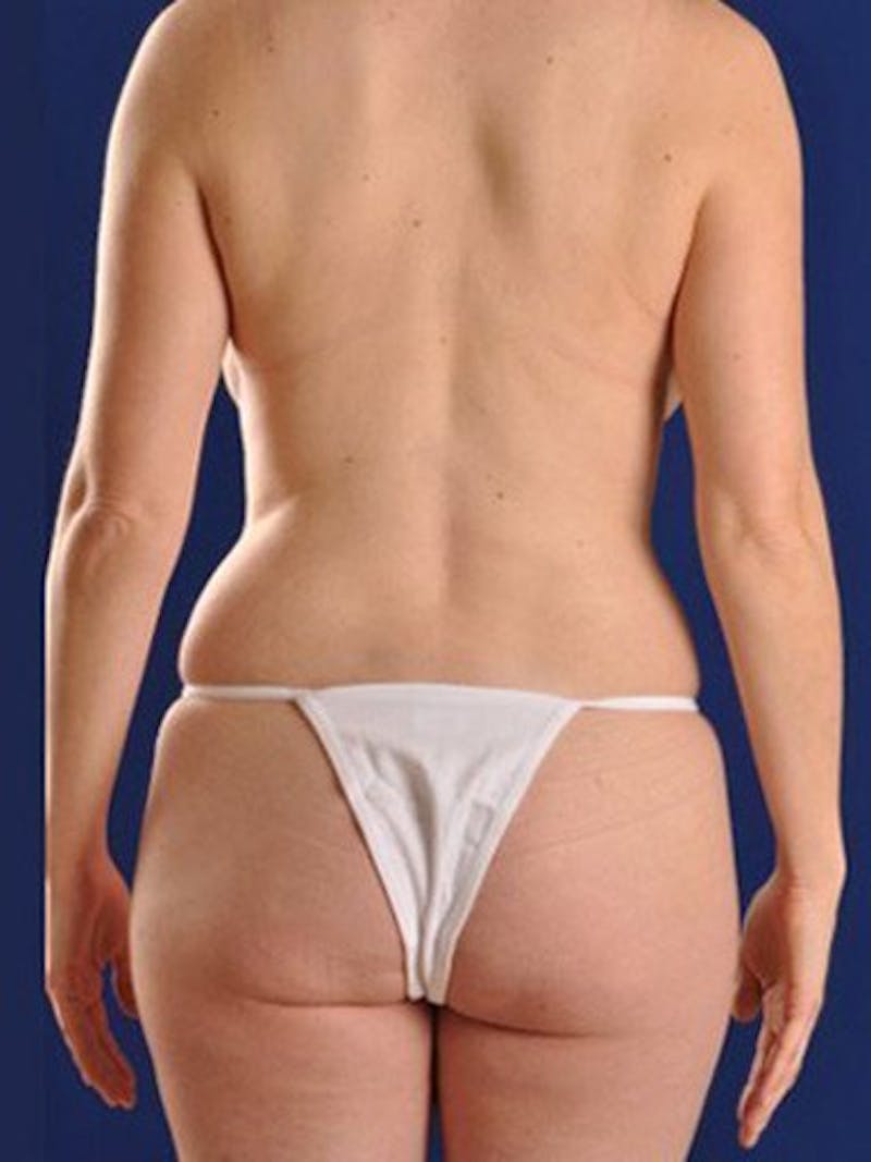 Fat Transfer Buttocks (Brazilian Butt Lift) Before & After Gallery - Patient 18264983 - Image 3