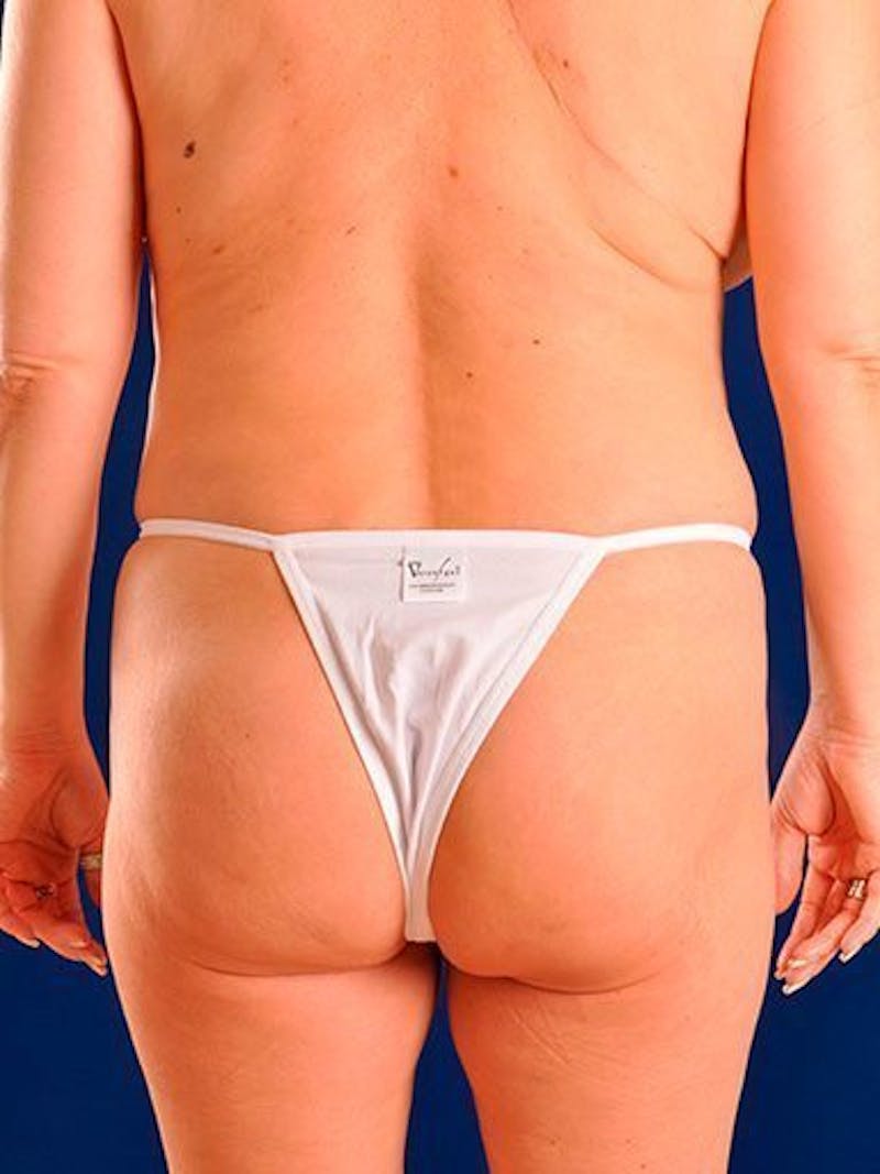 Fat Transfer Buttocks (Brazilian Butt Lift) Before & After Gallery - Patient 18264989 - Image 3