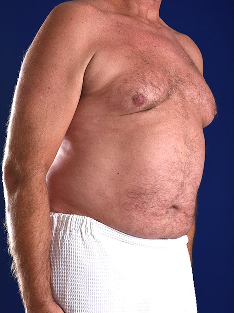 Gynecomastia Before & After Gallery - Patient 18264991 - Image 3