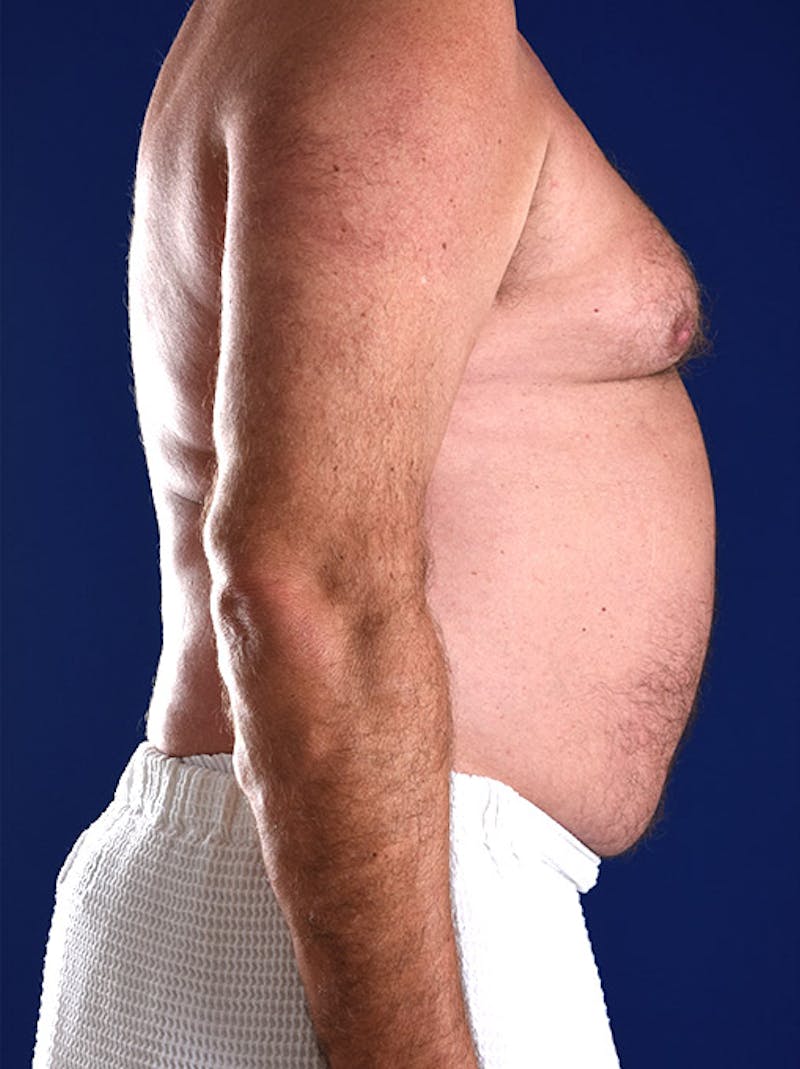 Gynecomastia Before & After Gallery - Patient 18264991 - Image 5