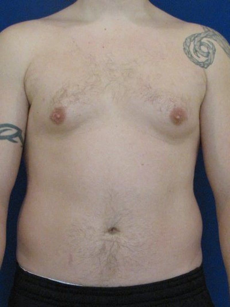 Gynecomastia Before & After Gallery - Patient 18268079 - Image 1