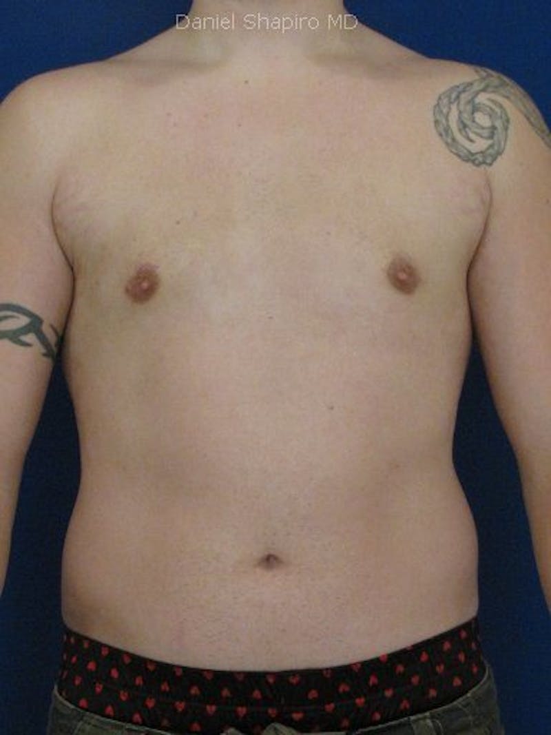 Gynecomastia Before & After Gallery - Patient 18268079 - Image 2