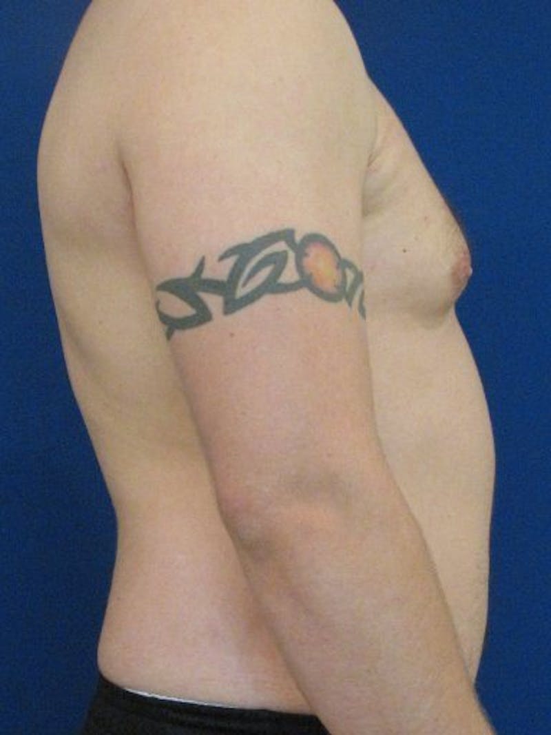 Gynecomastia Before & After Gallery - Patient 18268079 - Image 3
