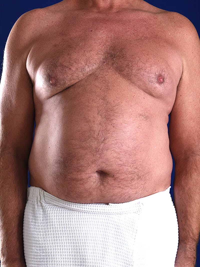 Liposuction Before & After Gallery - Patient 18268081 - Image 1