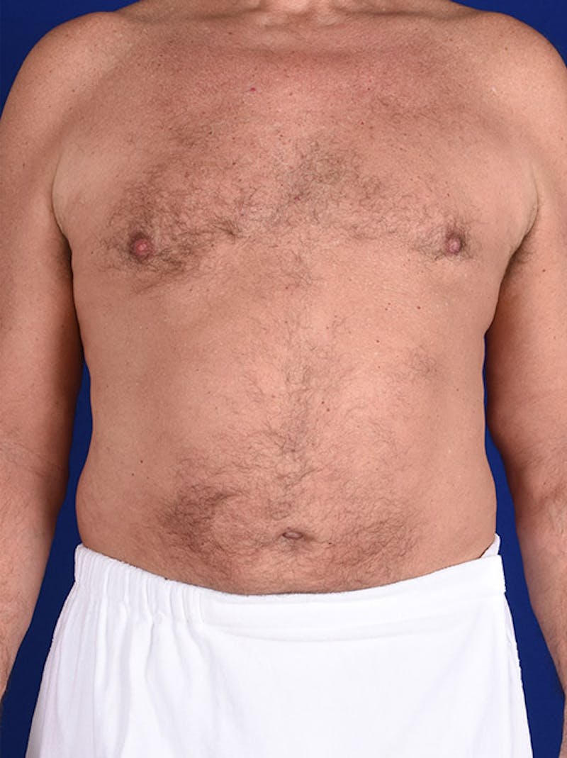 Liposuction Before & After Gallery - Patient 18268081 - Image 2
