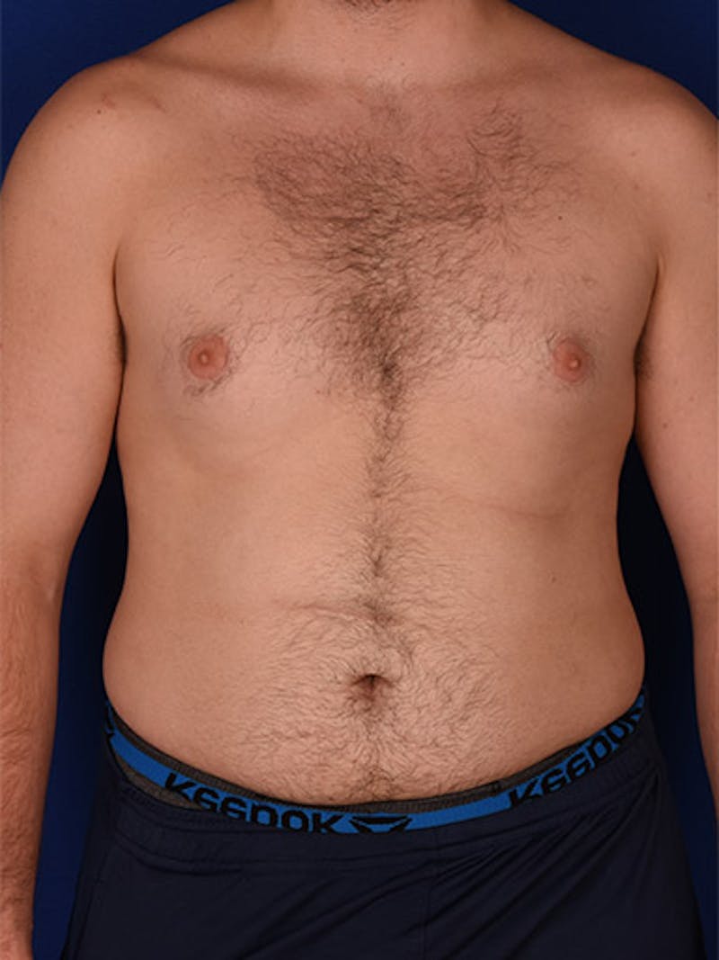 Gynecomastia Before & After Gallery - Patient 18268083 - Image 1