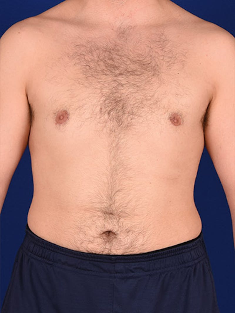 Gynecomastia Before & After Gallery - Patient 18268083 - Image 2