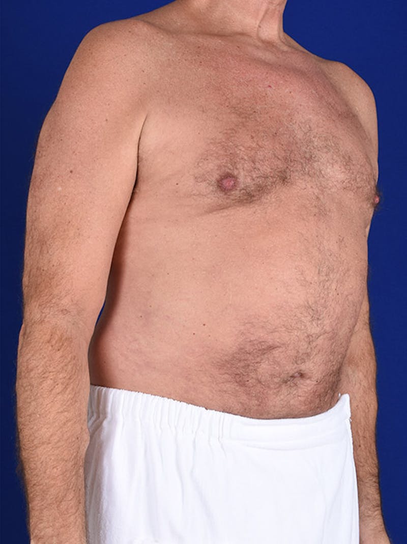 Liposuction Before & After Gallery - Patient 18268081 - Image 4