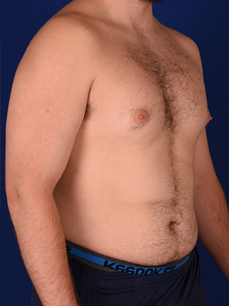 Gynecomastia Before & After Gallery - Patient 18268083 - Image 3