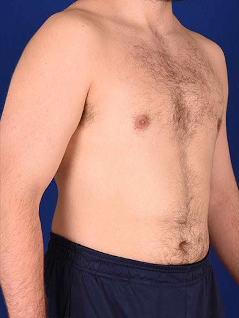Gynecomastia Before & After Gallery - Patient 18268083 - Image 4