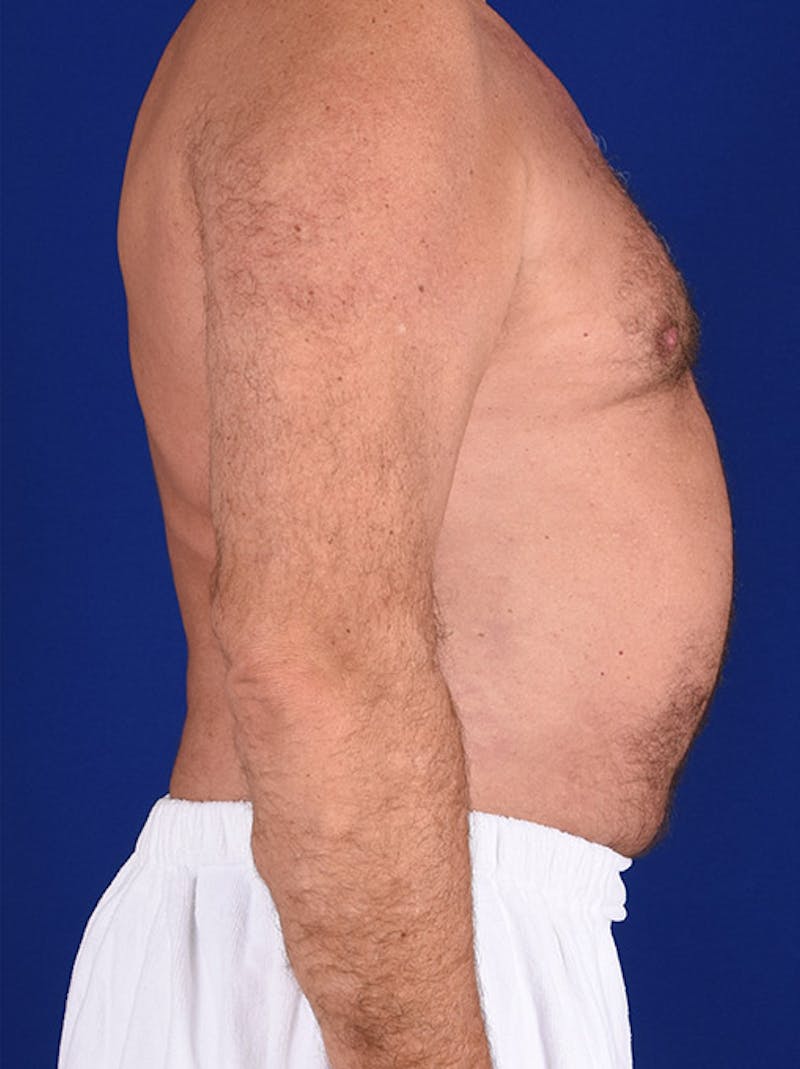Liposuction Before & After Gallery - Patient 18268081 - Image 6