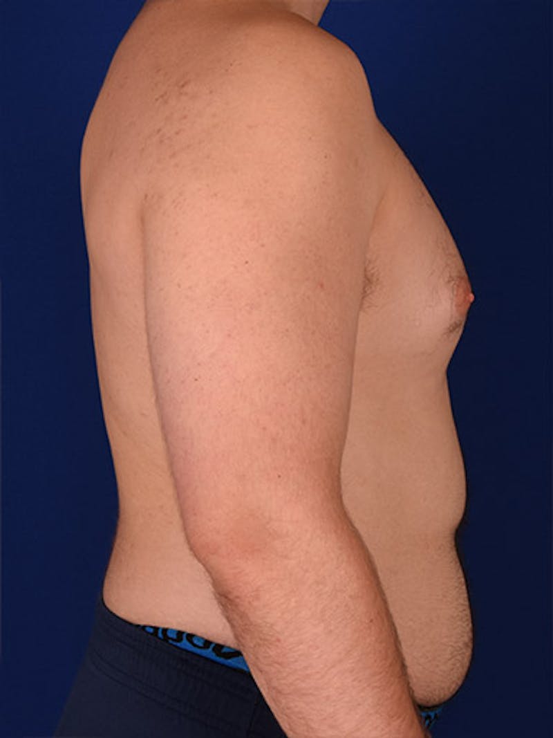 Gynecomastia Before & After Gallery - Patient 18268083 - Image 5