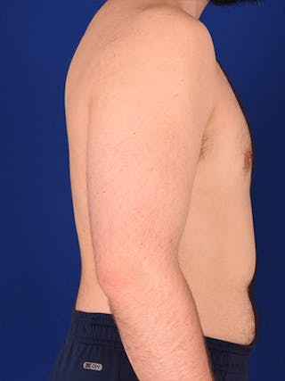 Gynecomastia Before & After Gallery - Patient 18268083 - Image 6