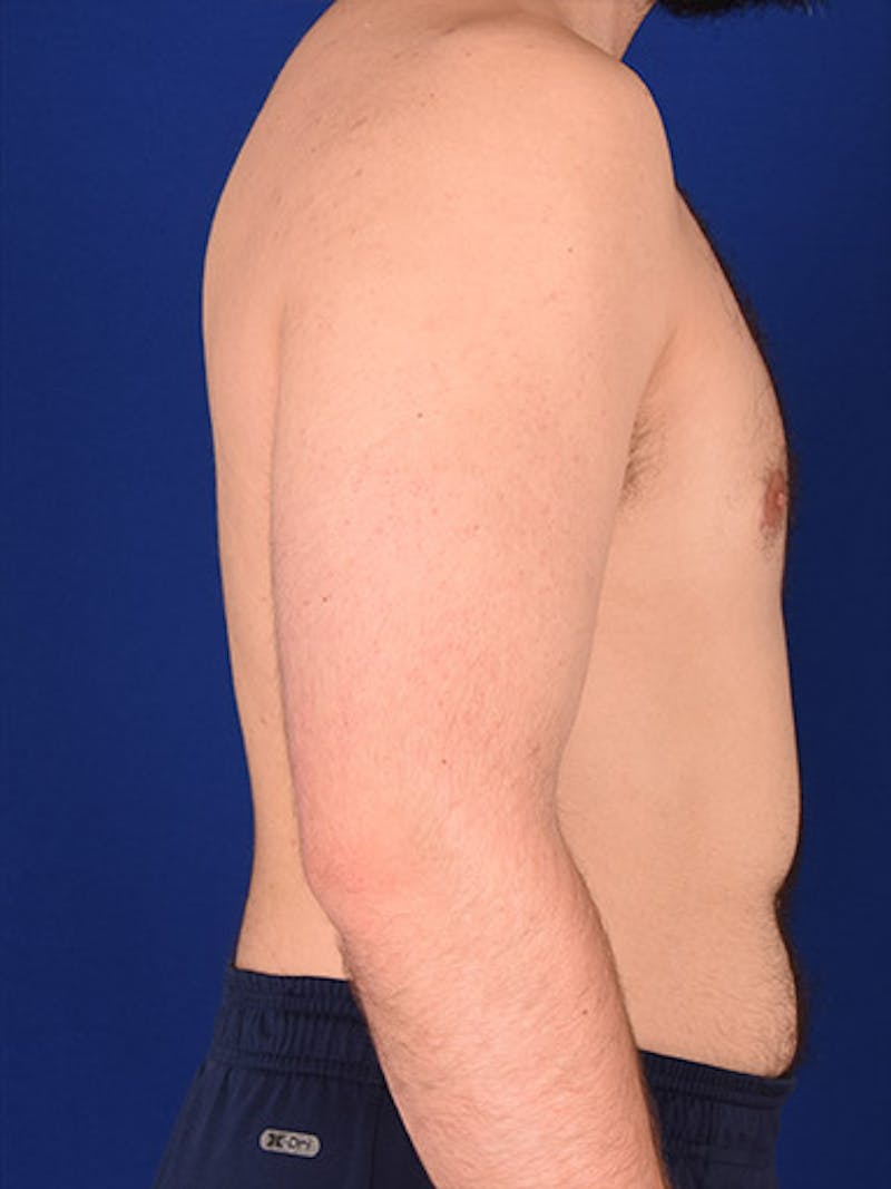 Gynecomastia Before & After Gallery - Patient 18268083 - Image 6