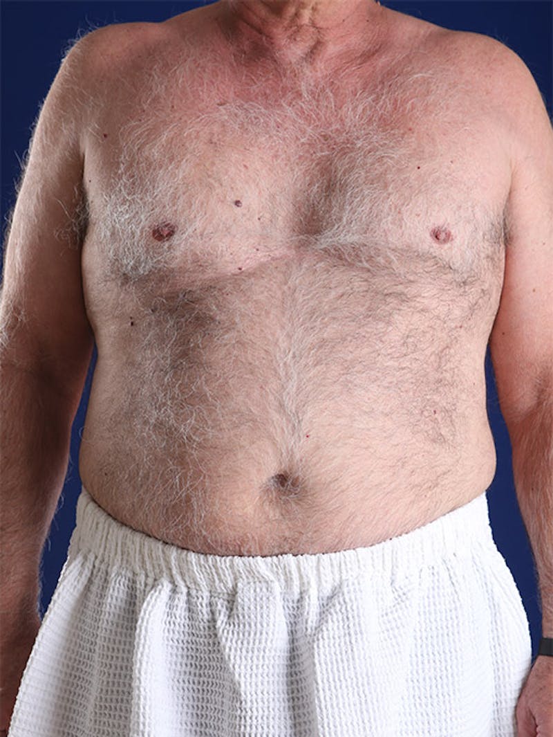 Liposuction Before & After Gallery - Patient 18268089 - Image 1
