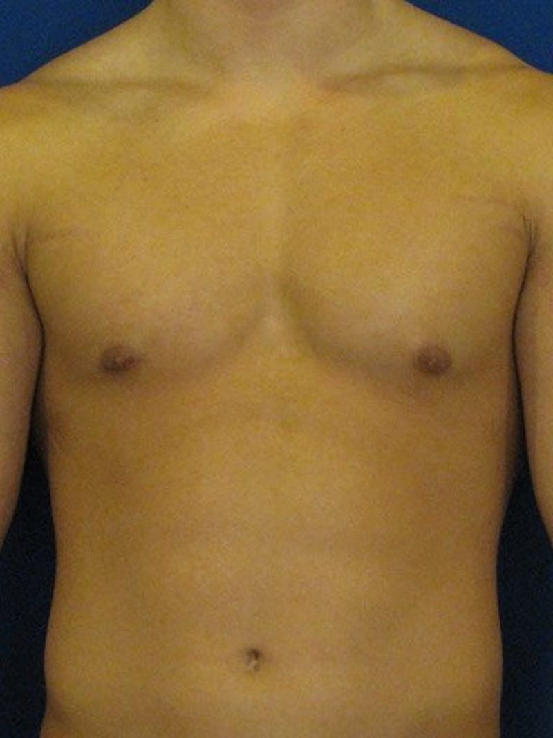 Gynecomastia Before & After Gallery - Patient 18268087 - Image 1