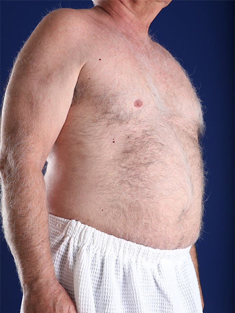 Liposuction Before & After Gallery - Patient 18268089 - Image 3