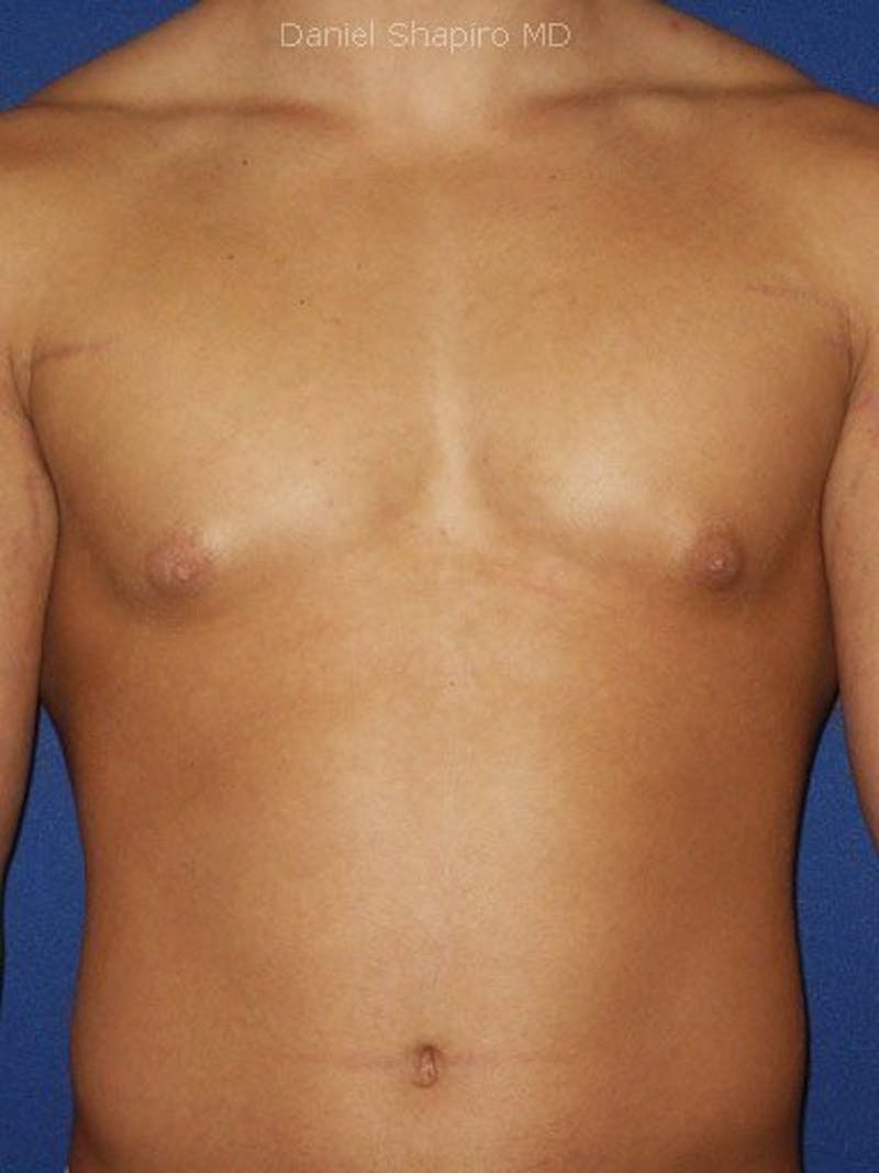 Gynecomastia Before & After Gallery - Patient 18268087 - Image 2