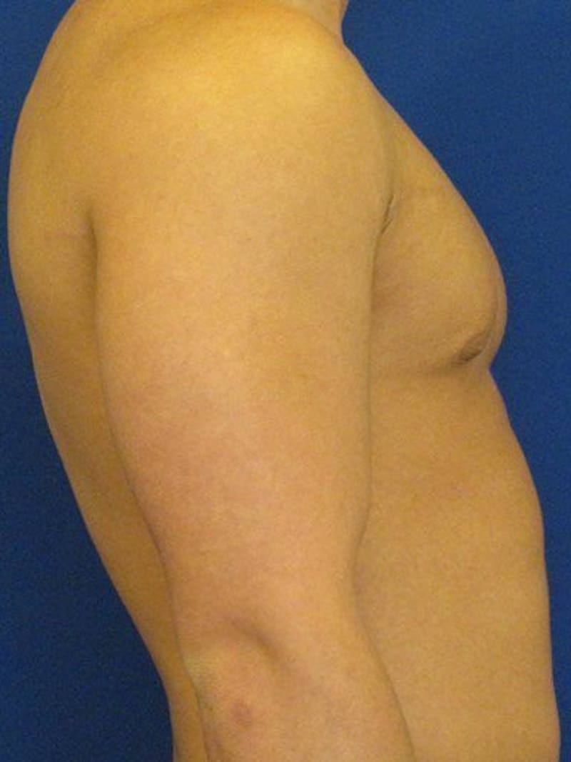 Gynecomastia Before & After Gallery - Patient 18268087 - Image 3