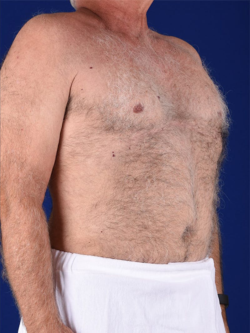 Liposuction Before & After Gallery - Patient 18268089 - Image 4