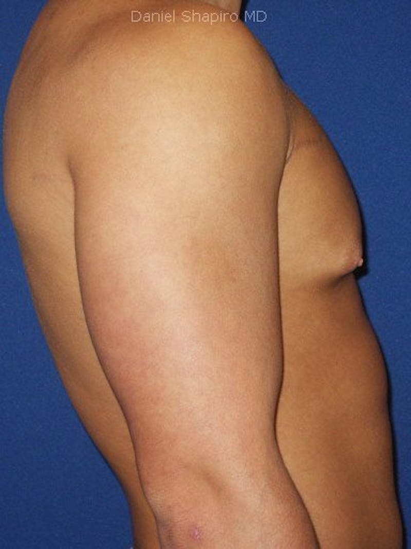 Gynecomastia Before & After Gallery - Patient 18268087 - Image 4