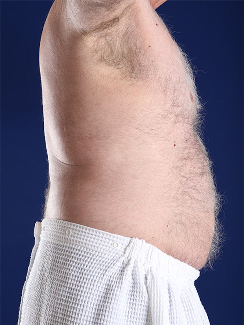 Liposuction Before & After Gallery - Patient 18268089 - Image 5