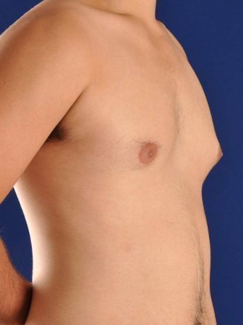 Gynecomastia Before & After Gallery - Patient 18268088 - Image 1