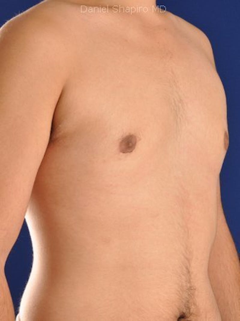 Gynecomastia Before & After Gallery - Patient 18268088 - Image 2